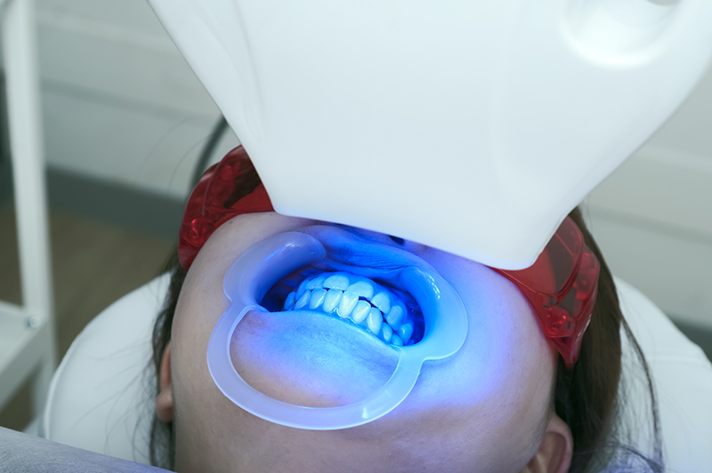 オフィスホワイトニング